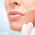 lip filler
