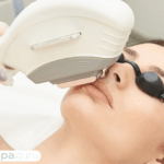 laser hair removal