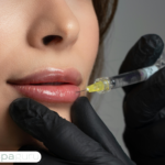 lip filler